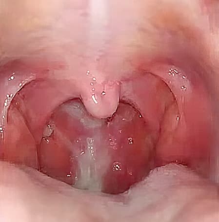 
        Ребенок с лор-патологией на приеме у ВОП и педиатра + аудио			
        
        