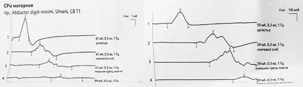 
			SARS-CoV-2 как триггер дебюта и прогрессирования неврологических заболеваний. Часть 2		