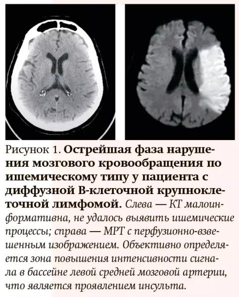 Лучевая диагностика при кровотечениях и тромбозах: плюсы и минусы разных методов                     
        Лучевая диагностика при кровотечениях и тромбозах: плюсы и минусы разных методов