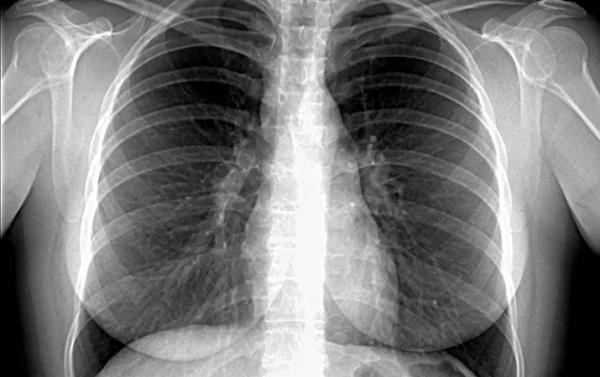 Саркоидоз: нерешенные задачи		 
			Саркоидоз: нерешенные задачи