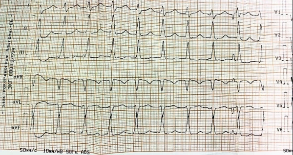 АВУРТ и АВРТ: лекарственная терапия или катетерная аблация?			     
        АВУРТ и АВРТ: лекарственная терапия или катетерная аблация?