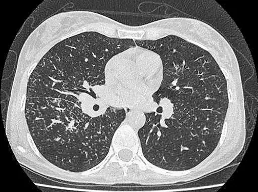 Саркоидоз: нерешенные задачи		 
			Саркоидоз: нерешенные задачи