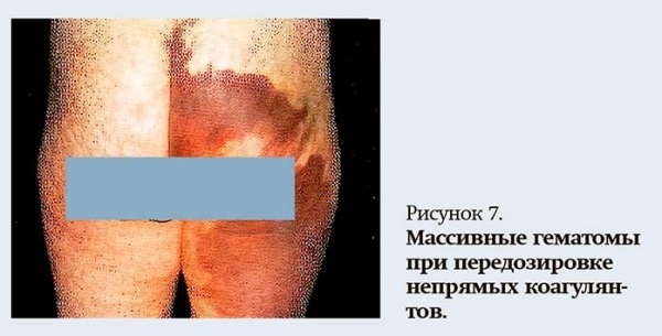 
        Геморрагический синдром: клиническая оценка и тесты                    