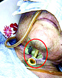 Онкологические заболевания гортани. Еще раз о важности регулярного наблюдения у профильных специалистов                     
        Онкологические заболевания гортани. Еще раз о важности регулярного наблюдения у профильных специалистов