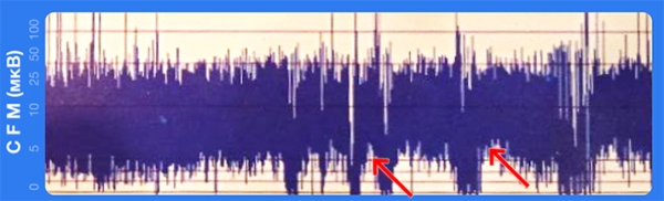 
        Терапевтическая гипотермия в неонатологии			    